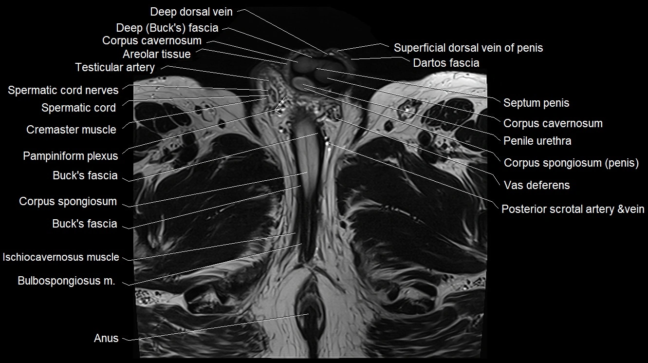 MRI 3T scrotum and penis axial cross sectional anatomy image 22.webp